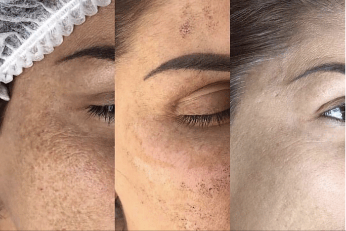 IPL before and after effective treatments