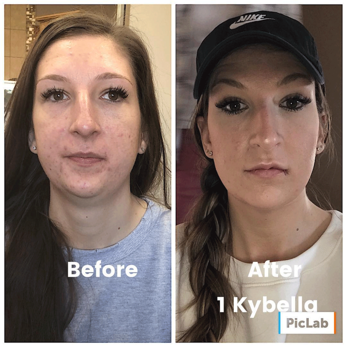 Kybella double shin treatment before and after