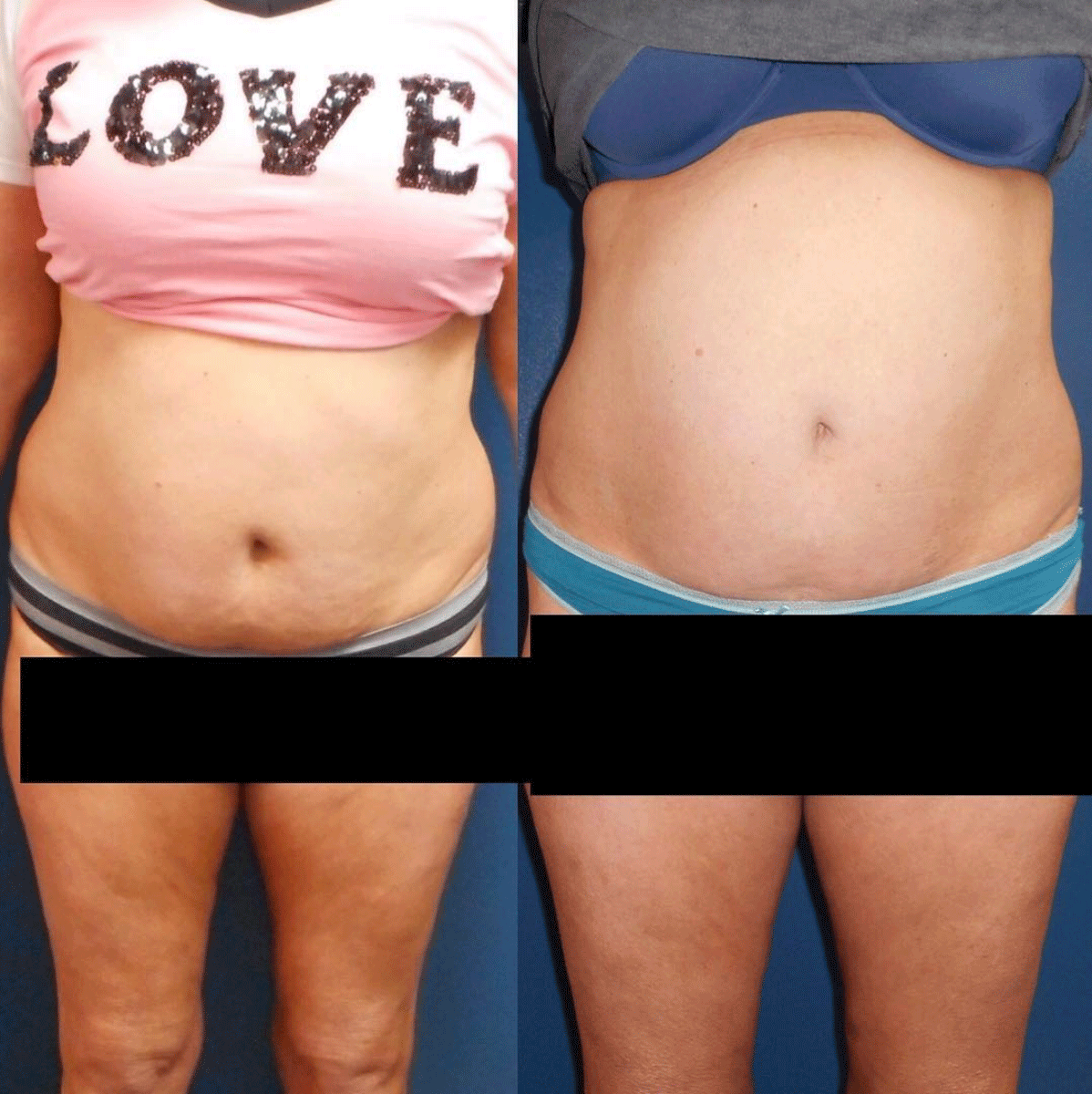 before and after of belly fat treatment