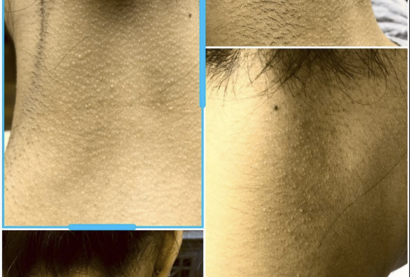 Laser hair removal after each treatment