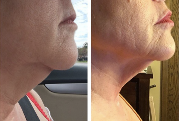 double chin, turkey neck treatment before and after