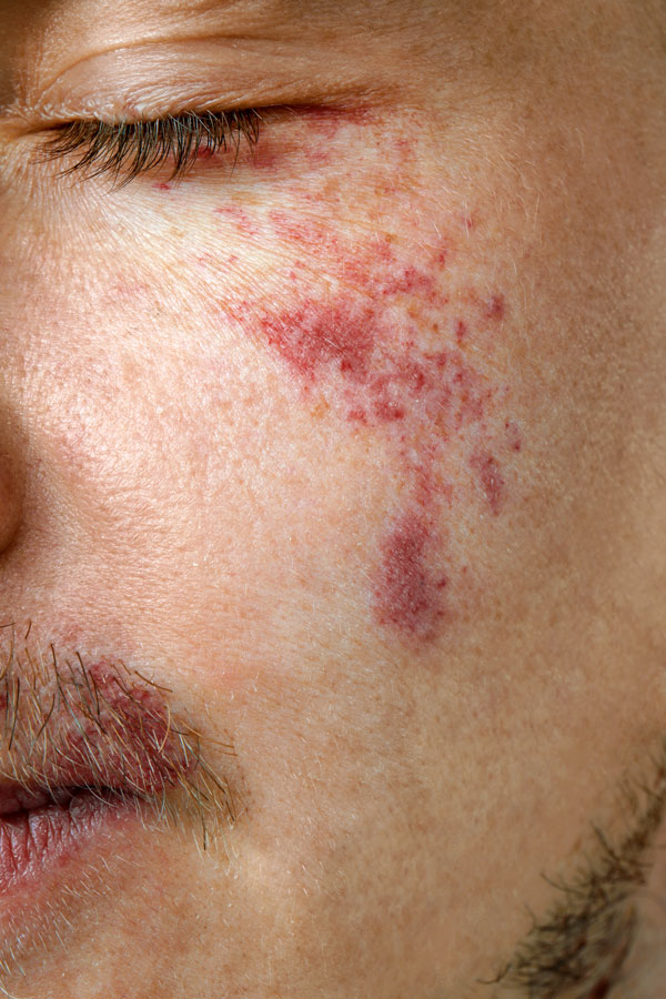 Stock pic of hyperpigmentation on young man
