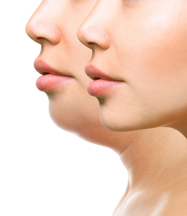 Before and after of stock image of double chin for Kybella treatment