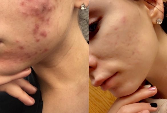 Joules MedSpa and Laser Center: ACNE BEFORE AFTER, shows clear skin in after