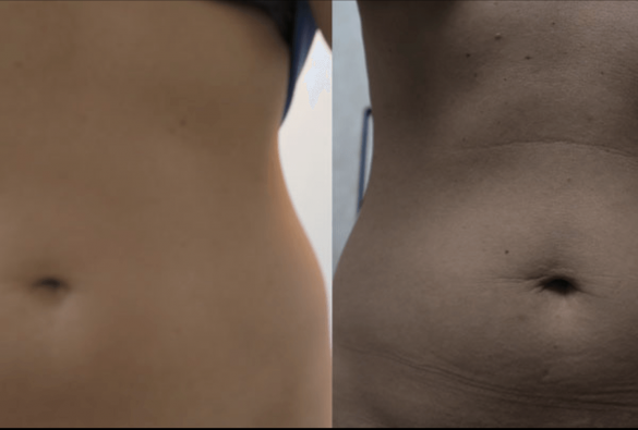 Joules MedSpa and Laser Center: first photo shows after of tighter skin and a tighter belly