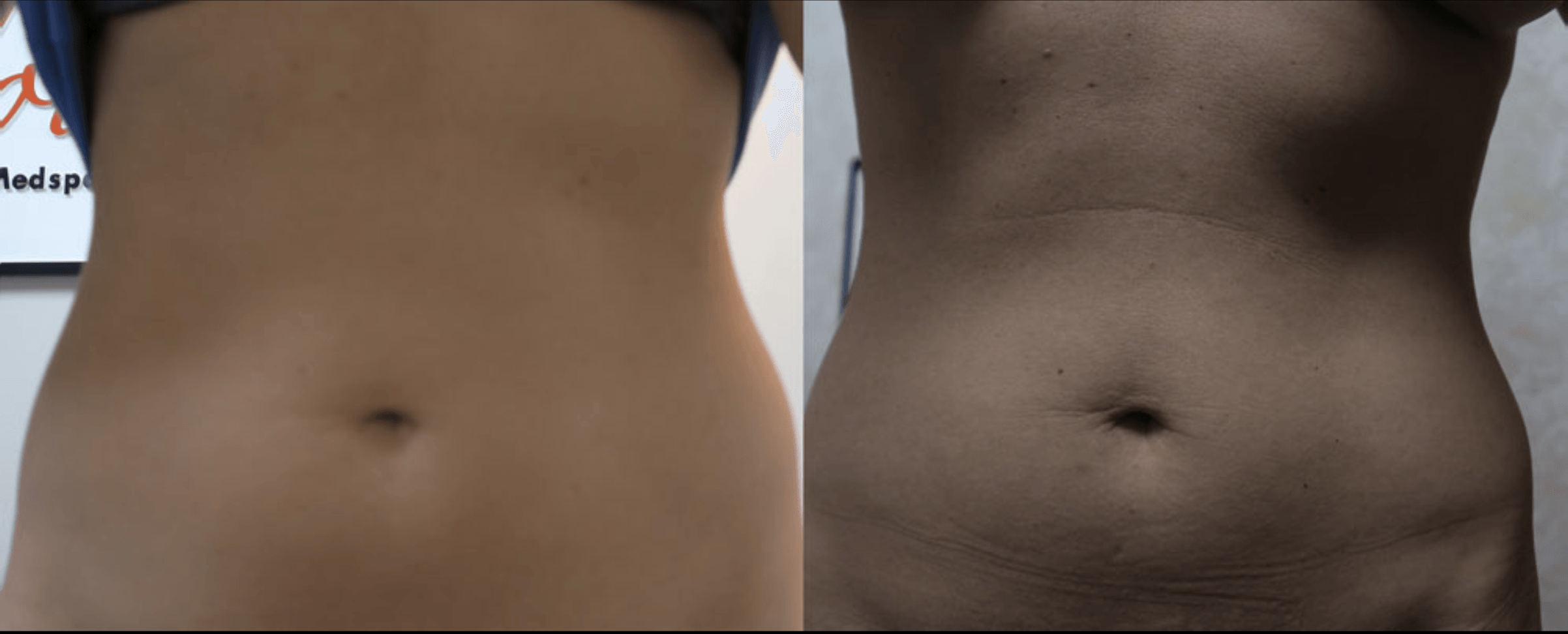 Joules MedSpa and Laser Center: first photo shows after of tighter skin and a tighter belly