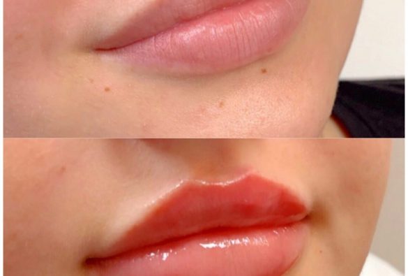 Joules MedSpa and Laser Center Lip Enhancement