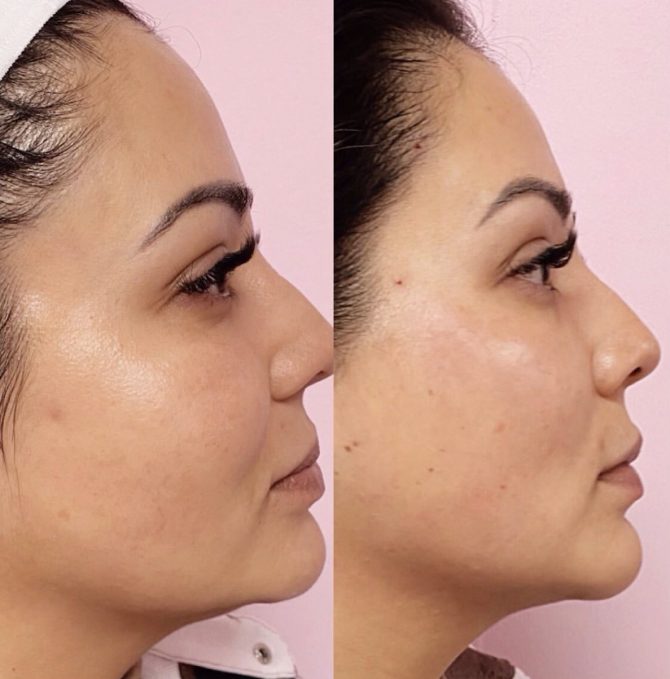 Soft PDO Thread Lift in Cheeks & Brows